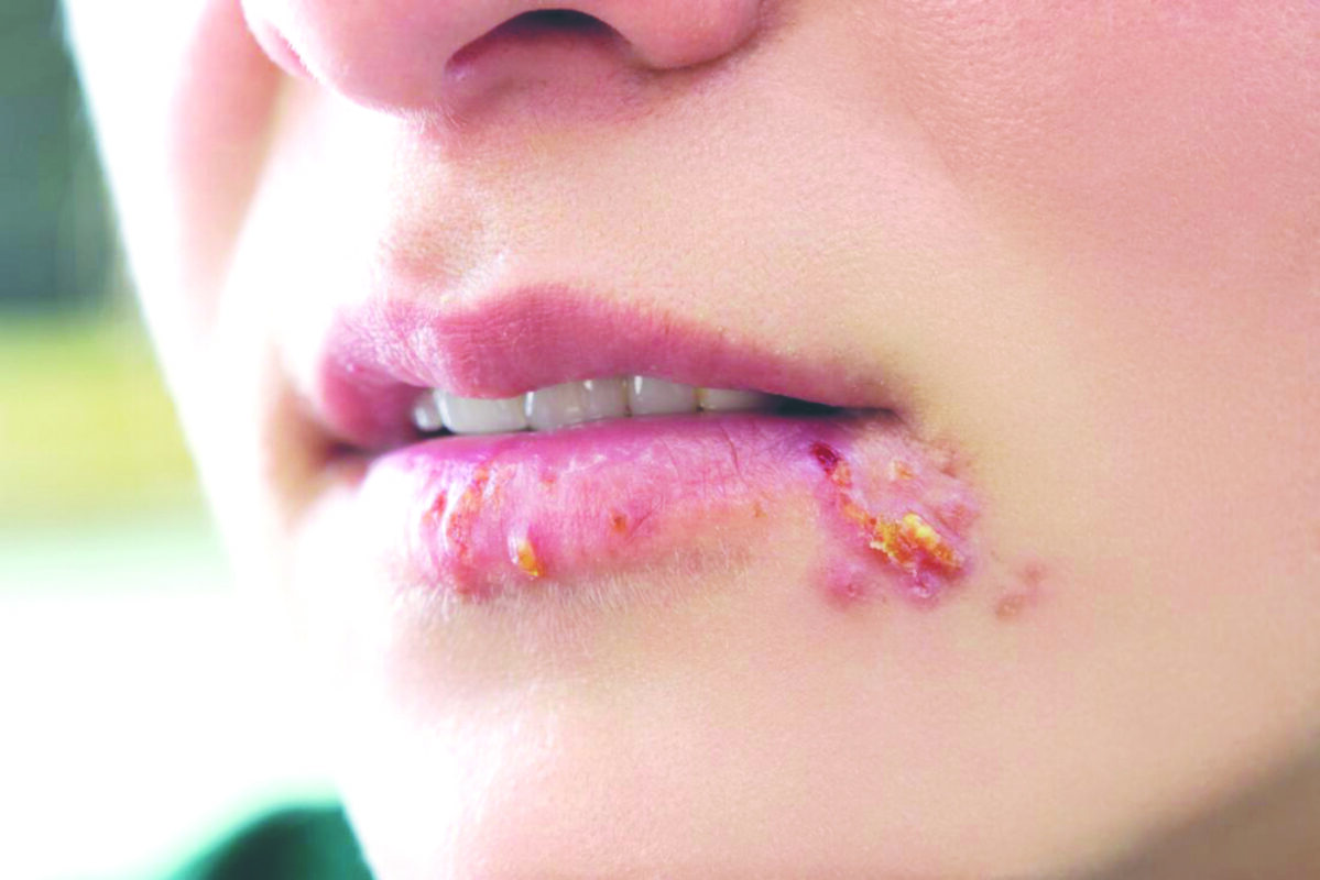 virus herpes mụn rộp ở môi