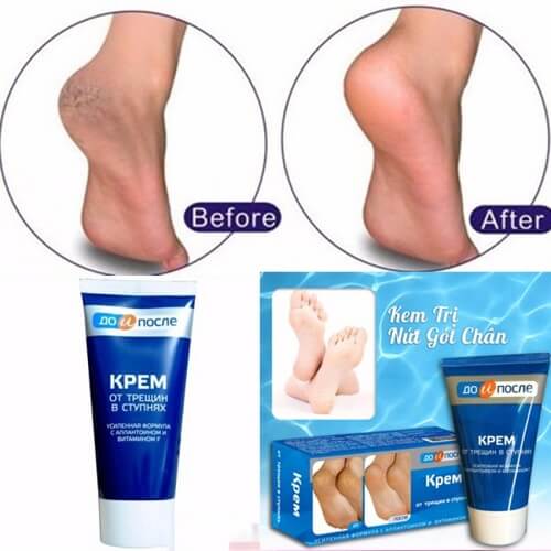 Kpem Apteka- cách chữa trị nứt gót chân hiệu quả